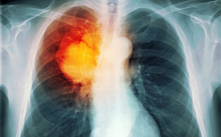 Cancer among workers at Fukushima Dai-ichi